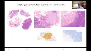 Sentinel lymph node in endometrial cancer [upl. by Newby]