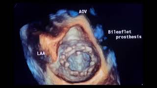 3Dview of cardiac prosthetic valves to drahmadmirdamadisiwlaQFIbeKfu1q [upl. by Sarazen]