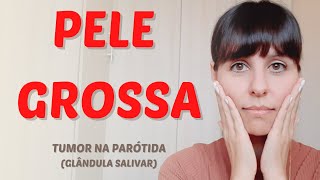 Pele grossa tumor na parótida [upl. by Rednirah]