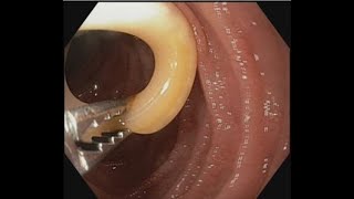 Ascariasis Removal from papilla BDENDOSCOPY [upl. by Acirema]