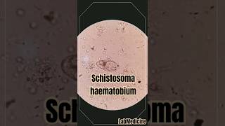 Schistosoma haematobium in urine  Clinical Parasitology [upl. by Naicul429]