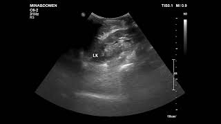 pleural fibrous tumor [upl. by Dimitris160]