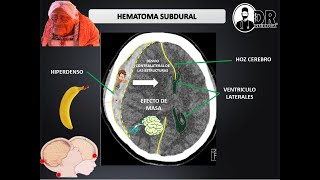 HEMATOMAS INTRACRANEALES EPIDURAL Y SUBDURAL  Como describir una Tomografía de cráneo [upl. by Yrevi]