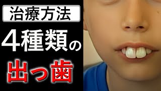 【タイプ別】出っ歯の改善法！それぞれのタイプ別に歯医者が解説 [upl. by Asha]