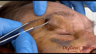 Draining a facial hematoma [upl. by Analahs]