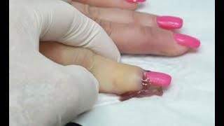 Worst Nail Infections of All Time Paronychia [upl. by Stafford]