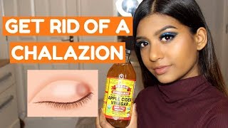 HOW TO GET RID OF A CHALAZION FAST AT HOME [upl. by Saks340]