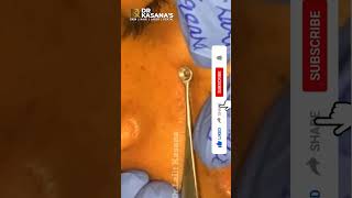 Dr Lalit Kasanas Treatments  How to Use Blackhead Removal Tool [upl. by Abate]