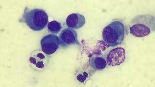 Mesothelial cells in effusion [upl. by Selmner]