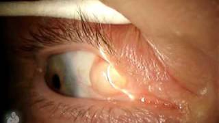 Ophthalmology finding Inclusion cyst on the eye [upl. by Elleirbag]