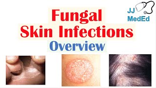 Overview of Fungal Skin Infections  Tinea Infections [upl. by Winni]