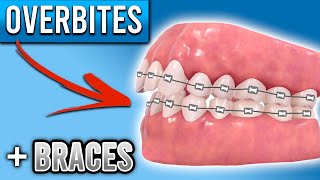 How Do BRACES FIX Overbites  Overbite Before and After Braces  Premier Orthodontics [upl. by Ahcsim431]