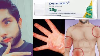 DermazinSilver Sulfadiazine Cream uses side effectstreatment for burningrashes [upl. by Angel]