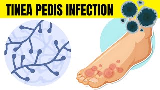 Tinea Pedis Infection Athletes Foot  Causes Types Signs amp Symptoms And Treatment [upl. by Lordan]