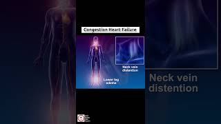 Congestive Heart Failure CHF  cardiology [upl. by Beau]