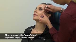 Ultherapy Treatment on Brow amp Crows Feet [upl. by Sivle]