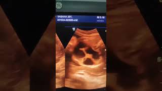 Fetal bowel dilatation Ultrasound shorts video shorts [upl. by Catrina7]