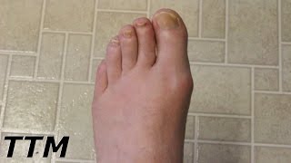 Big Toe Pain From Nerves or GoutLower Back and Leg PainNerve Pain in Foot [upl. by Clarice]