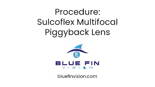 Sulcoflex Multifocal Piggyback Lens  4 [upl. by Isaacs722]