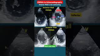 RWMA of Anterior Wall Echo l Part2 l हार्ट अटैक इको echo shorts [upl. by Solrac567]