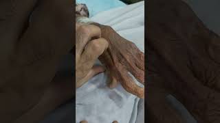 Osteoarthritis of fingers  Heberdens Nodes [upl. by Lamrouex]