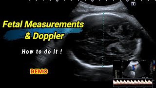 Fetal measurements and Doppler  How to do it [upl. by Einnep]