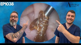 Satisfying Ear Wax amp Skin Removals  EP1038 [upl. by Ahsetra917]