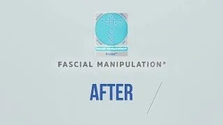 BEFORE amp AFTER FASCIAL MANIPULATION 2 [upl. by Worrell]