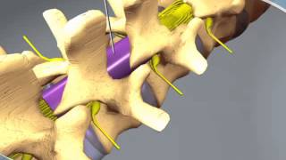 What to expect during an Epidural Steroid Injection at RAYUS [upl. by Ferdie536]