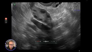 antral follicle count [upl. by Santa]