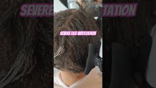 Lice Infestation l lice removal l small business explore hair lice hairvideo [upl. by Affrica]