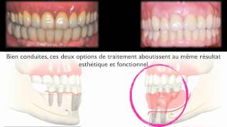 Implants dentairesampEdentement total mandibulaire resorbéImplantsampResorbed edentulous mandible [upl. by Oeniri]