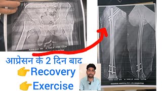 FEMUR BONE FRACTURE  EXERCISE amp RECOVERY AFTER 2 DAYS OF OPERATION [upl. by Raimes]