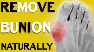 How to Treat Bunions 3 Simple Methods to Get Rid of Bunions  Without Surgery [upl. by Einafats]