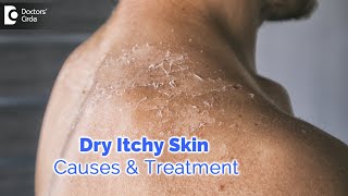 Dry itchy skin all over body Causes Diagnosis Treatment  Dr Rashmi Ravindra  Doctors Circle [upl. by Marita]