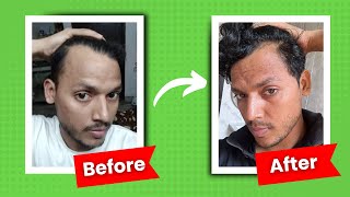 Traya Results Before and After  Traya Hair Review  Traya Hair Treatment Reviews  Traya Results [upl. by Sello]