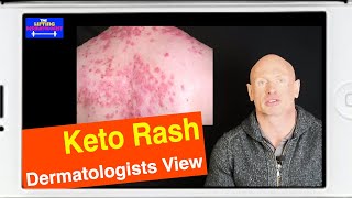 Keto Rash  Ketogenic Rash  Dermatologists View [upl. by Lemaj]