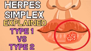 Herpes Simplex  Type 1 vs Type 2  EXPLAINED IN 2 MINUTES [upl. by Chaworth]