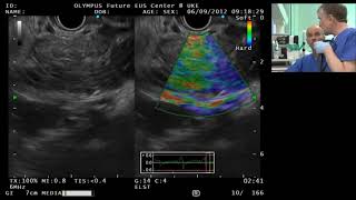 EUS in a patient with chronic pancreatitisand dilation of the pancreatic duct [upl. by Anivlac]