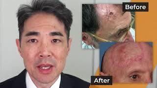 900 Reconstructed Scalps after Skin Cancer —Video Discussion by Matthew Hanasono MD [upl. by Kraul]