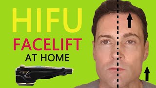 HIFU Face Lift At Home Skin Tightening Device Review [upl. by Nellad216]