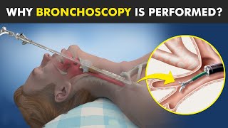 Bronchoscopy  Procedure To View Inside Of Air Ways [upl. by Hoxsie]