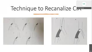 Aortoiliac Disease Endovascular Treatment [upl. by Decca823]