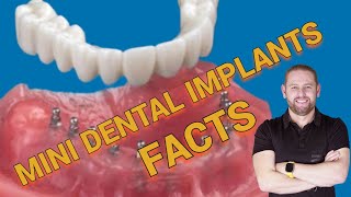 SHOCKING SNAP IN DENTURE FACTS COMPARED TO ADS [upl. by Atlante120]