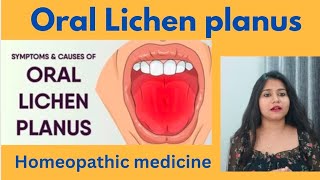 Oral lichen planus treatment  Oral lichen planus symptomscauses amp homeopathic medicine in hindi [upl. by Osric]