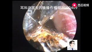 Another huge cerumenearwax in the ear16mins [upl. by Ocram]