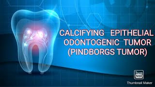 CALCIFYING EPITHELIAL ODONTOGENIC TUMOR PINDBORGS TUMOR [upl. by Drye]