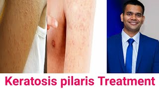 Keratosis Pilaris Cause Symptoms Ayurvedic Treatment [upl. by Ahsemo994]