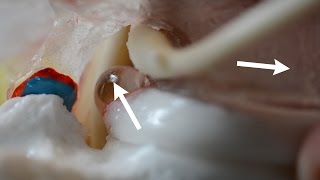 Unroofing of Disc Material with Spondylolisthesis  Modeled [upl. by Rehctelf]