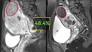 Uterine Fibroid Embolization for multiple symptomatic Fibroids [upl. by Amehsyt]